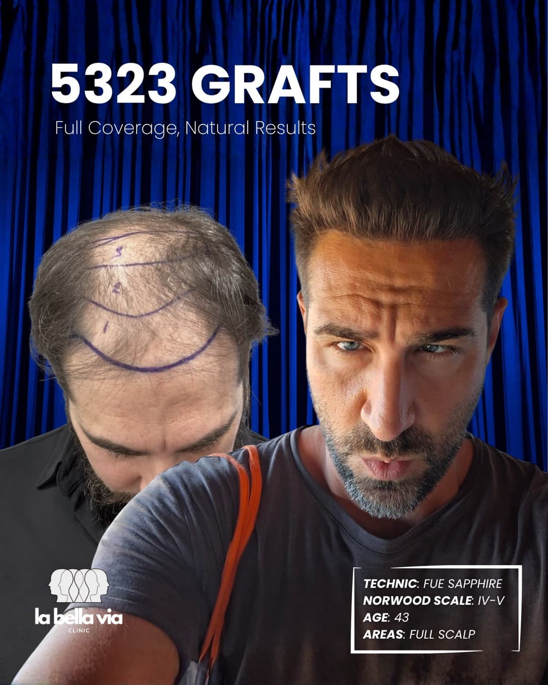 5,323 grafts · Full scalp · male, 43
