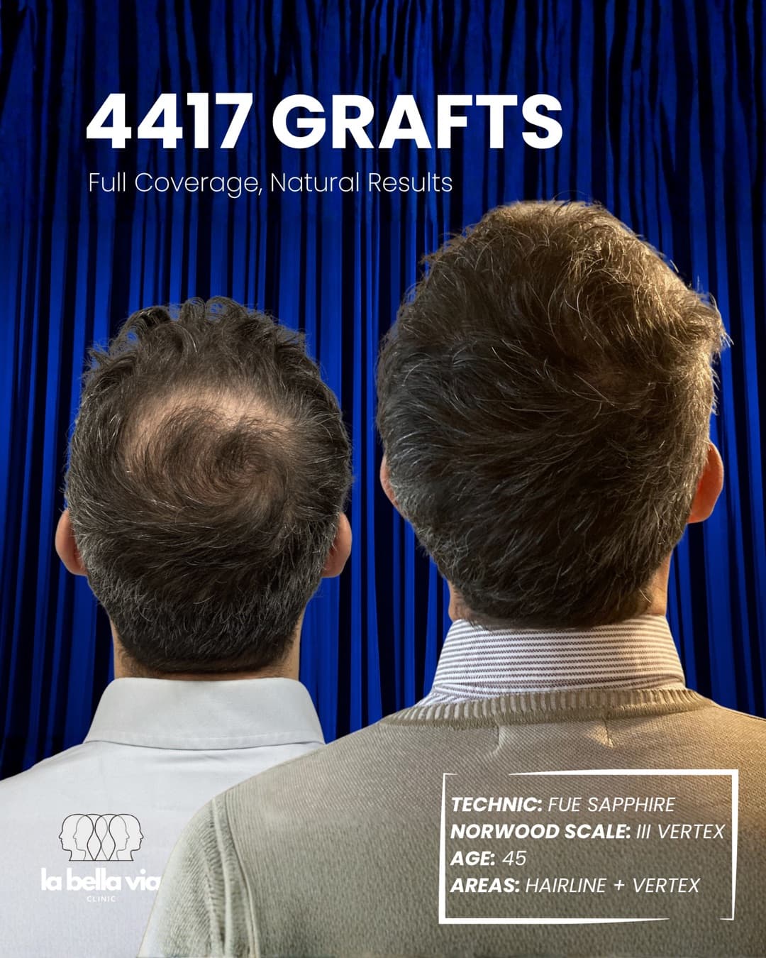 4,417 grafts · Hairline + vertex · male, 45