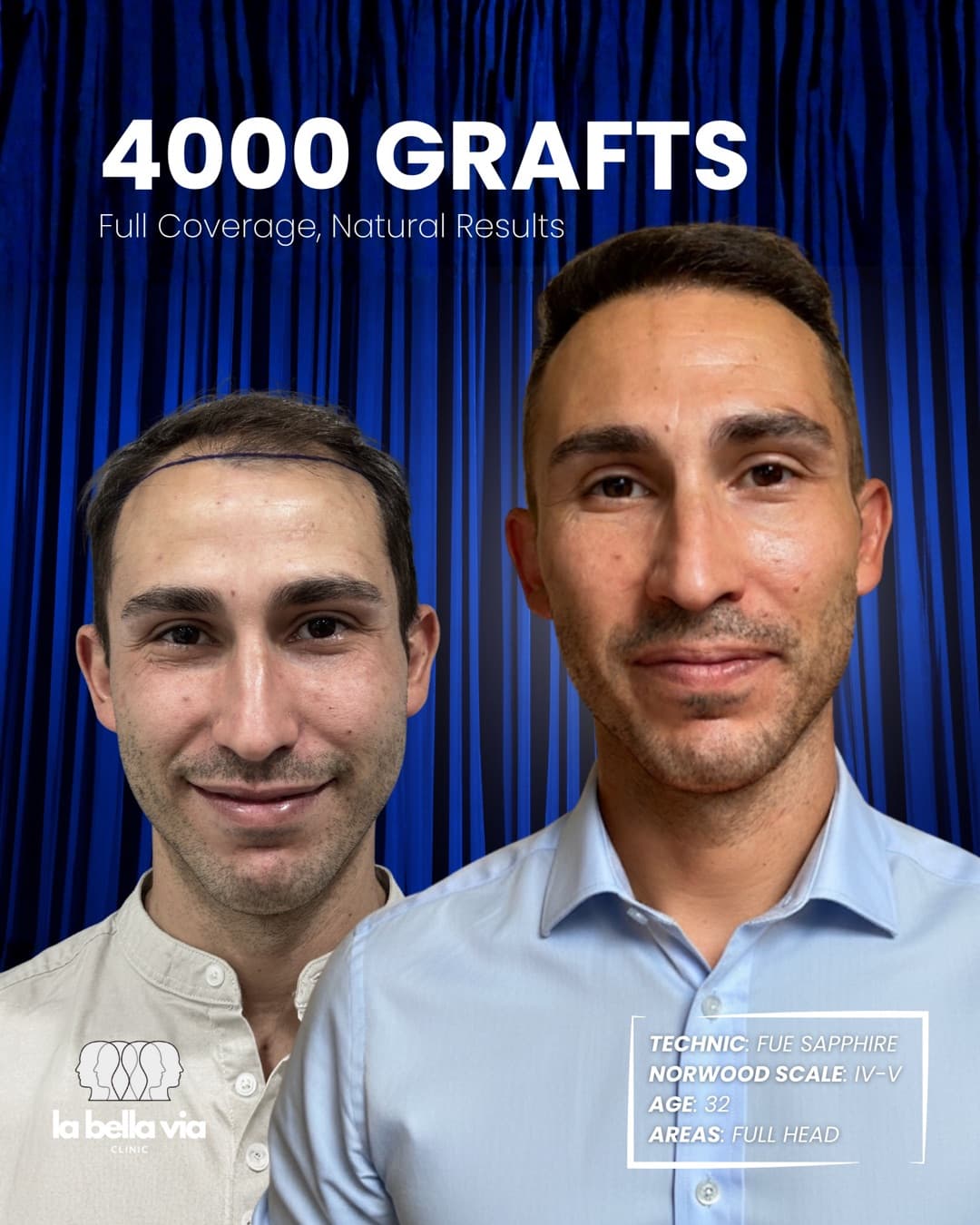 4,000 grafts · Full head · male, 32