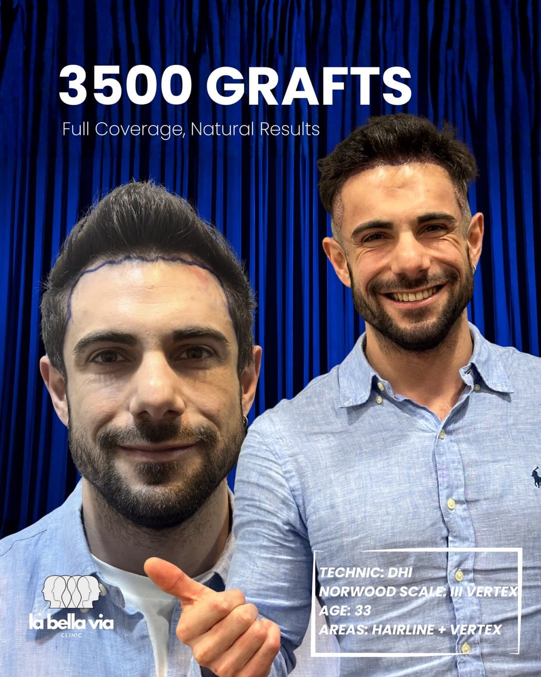 3,500 grafts · Hairline + vertex · male, 33