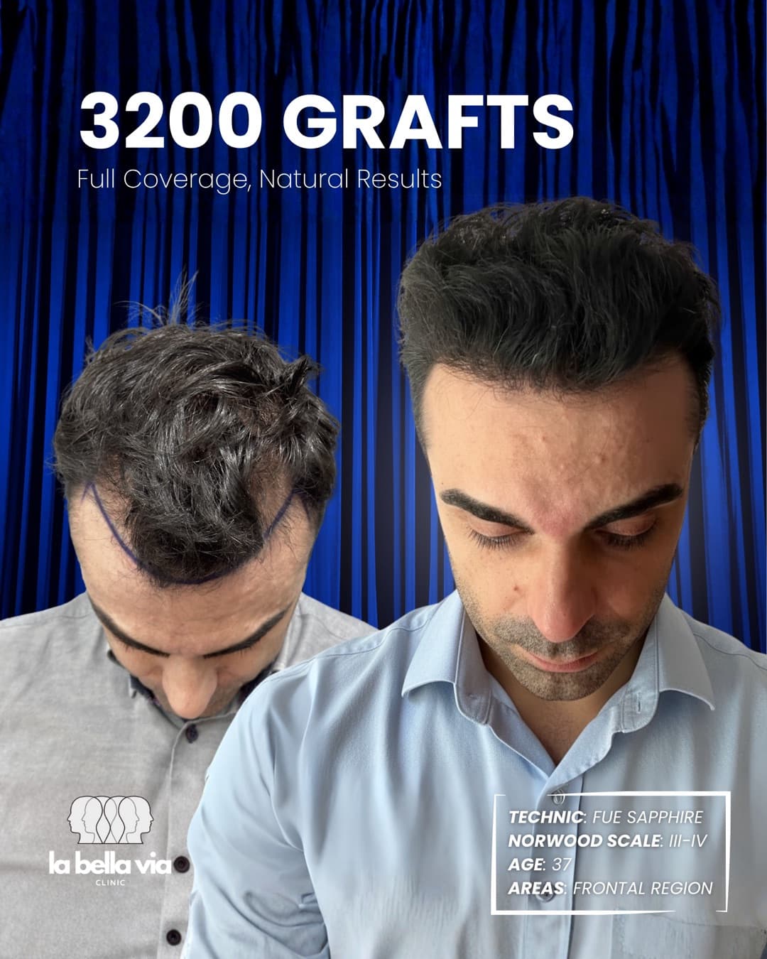 3,200 grafts · Frontal region · male, 37